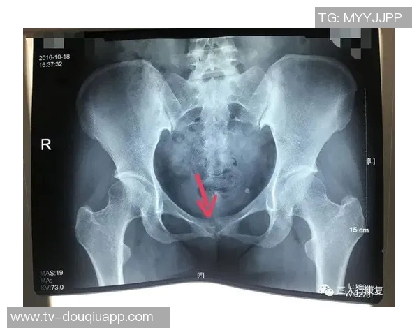 医生解析耻骨炎对亚马尔的影响及其过度使用损伤的成因与后果 医生解析耻骨炎对亚马尔的影响及其过度使用损伤的成因与后果